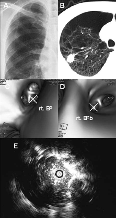 Figure From Transbronchial Biopsy Using Endobronchial Ultrasonography