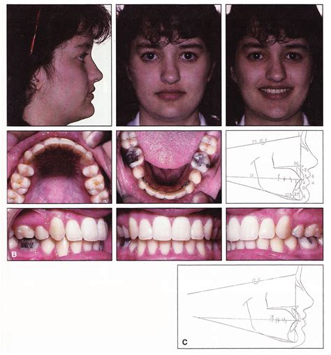 Optimum Teeth Positioning Based On Maxillary Incisors