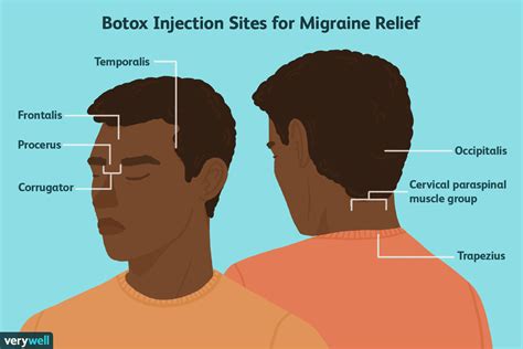Botox Zur Migräneprävention Verwenden Medde