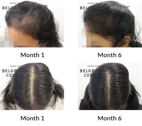 Hair Growth Success Story Amazing Results In Just 6 Months