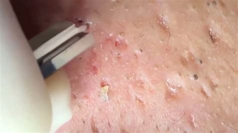Cyst Popping Cystic Acne Blackhead And Whitehead Removal New Nose