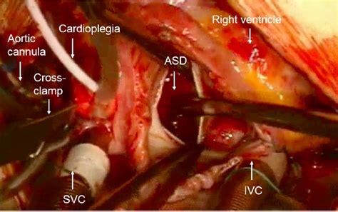 Image Showing The Heart Of A Child Born With An Atrial Septal Defect