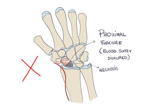 Scaphoid Fractures How To Not Miss Them Pro Doctor