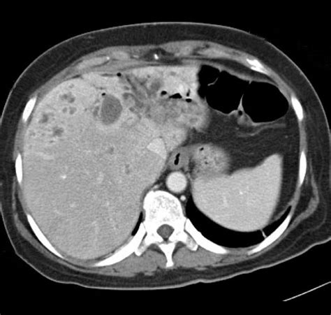 Abdominal Ct Scan Showing Multiple Stones In The Cbd And Ihd With