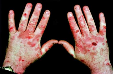 Cutaneous Porphyria Vampires Disease Au Science Wiki