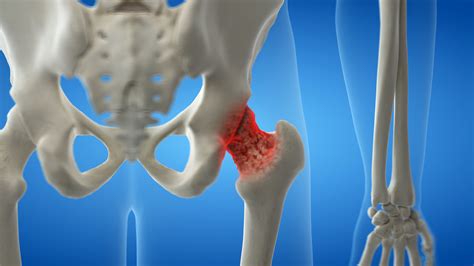 3d Rendered Medically Accurate Illustration Of An Arthritic Hip Joint