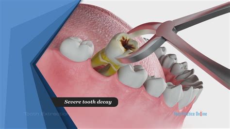 Tooth Extraction Video Medical Video Library