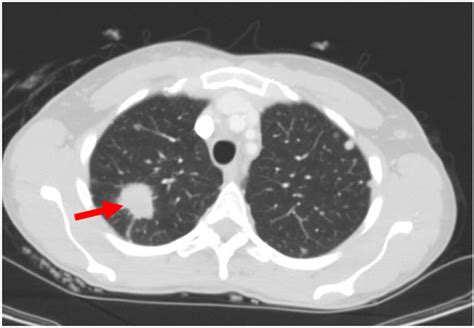 Figure 5 Ct Of The Chest Demonstrating A Spiculated Lung Mass In The