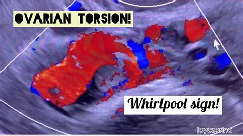 Ovarian Torsion With Whirlpool Sign Real Time Ultrasound Youtube