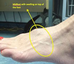 Cyclops Generalize Double Ganglion Cyst On Top Of Foot Continental Ten