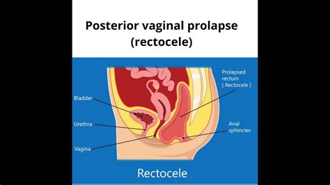 Posterior Vaginal Prolapse Rectocele Sri Lakshmi Multi Speciality Hospital Slmsh Youtube