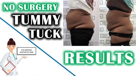 Belly Fat Reduction Without Surgery Non Surgical Tummy Tuck In London
