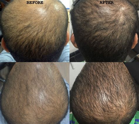 Platelet Rich Plasma Prp Treatment For Hair Loss Visakha Institute Of Skin And Allergy