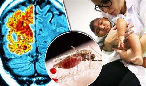 Zika Virus Causes Brain Damage Similar To Alzheimers Disease