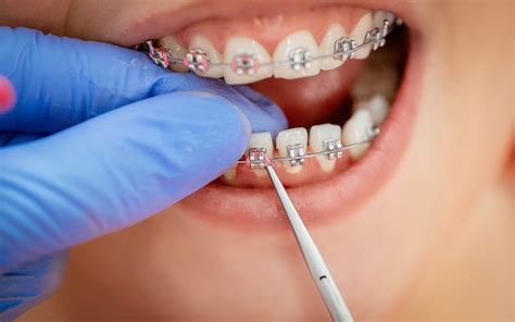 What Is The Best Age To Get Braces Bennion Lambourne Orthodontics