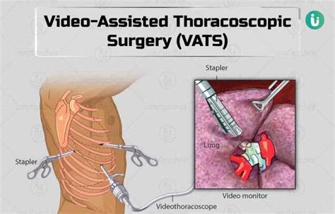 Video Assisted Thoracoscopic Surgery Vats Procedure Purpose Results Cost Price