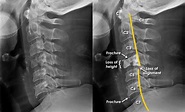 Trauma X-ray - Axial skeleton gallery 1 - Cervical spine - Fractures