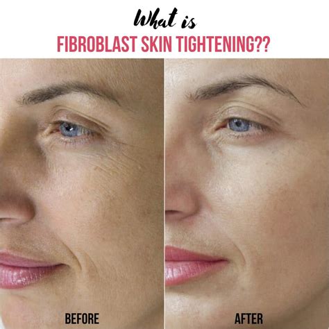 What Is Fibroblast Plasma Skin Tightening Lashx