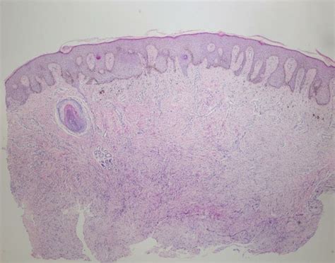 A Lesion With Acanthosis On The Epidermis Increased Basal Layer