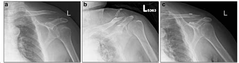 A 32 Year Old Male With A Left Distal Clavicle Fracture Neer Type