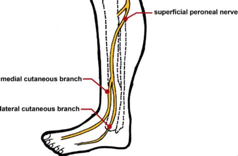 Common Peroneal Neuropathy