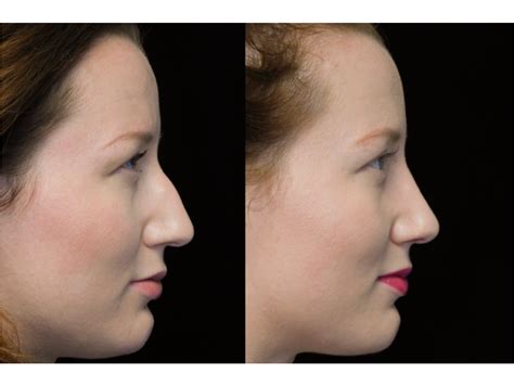 Getting A Bulbous Nose Job Scarless Med Spa By Deepak Dugar Md