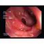 Short Angled Segment In The Sigmoid Colon With Diverticular Disease 