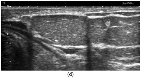 Cancers Free Full Text Retroareolar Carcinomas In Breast Ultrasound