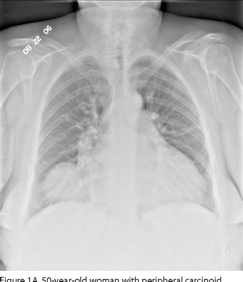 Figure 1 From Peripheral Bronchial Carcinoid Tumor Presenting As A