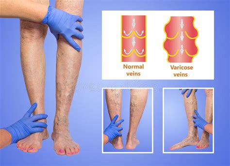 Varicose Veins On A Female Senior Leg Stock Photo Image Of Patient