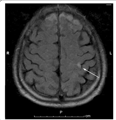 T2 Weighted Brain Magnetic Resonance Image Showing An Area Of