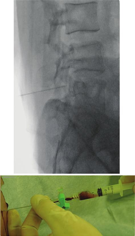Fluoroscopic Guided Lumbar Puncture A Was Performed And Macroscopic