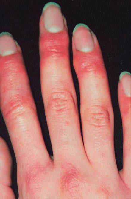 Red Swollen Tender Fingers In Pernio Patient 5 Download Scientific Diagram