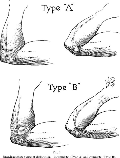 Figure 1 From Recurrent Ulnar Nerve Dislocation At The Elbow