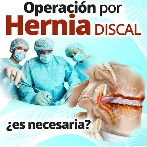 La Operaci N Por Hernia Discal Es Necesaria Cordus Colombia