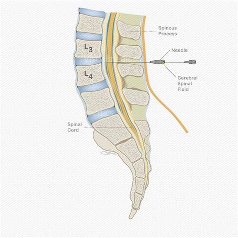 Lumbar Puncture Medical Kit Visualmedics