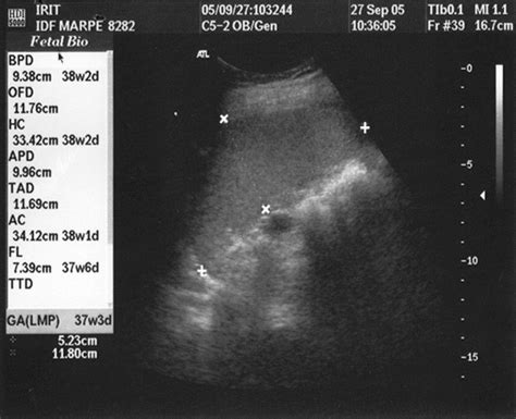 Normal Sonographic Values Of Maternal Spleen Size Throughout Pregnancy
