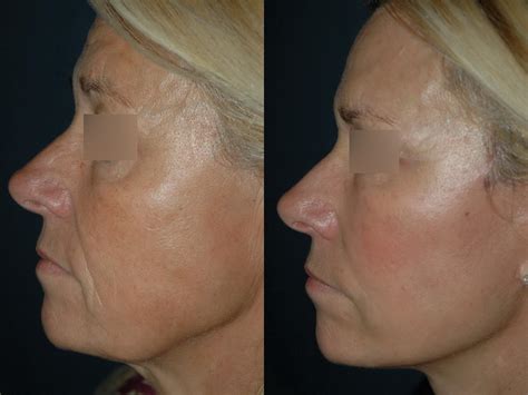 photos avant et après des liftings du visage les mieux réussi