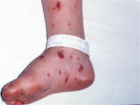 Manly Meningococcal Outbreak Students And Teachers Offered Antibiotics
