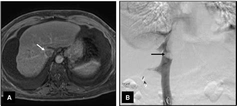 A Mri Of The Abdomen Showing Nodular Contour Of The Liver With