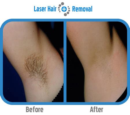 Laser hair removal prices vary based on who is providing the service (an assistant, a nurse, or a doctor), what area is receiving treatment, and how much hair there is to remove. Underarm Laser Hair Removal | Laser Hair Removal