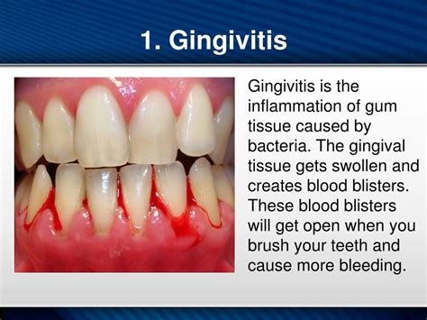Ppt What Causes Bleeding Gums Powerpoint Presentation Free Download