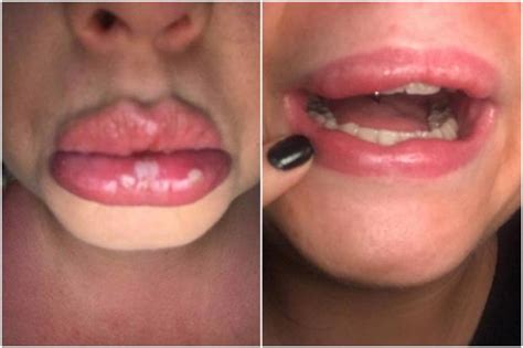 Scots Women Left Suicidal And In Agony After Botched Lip Fillers