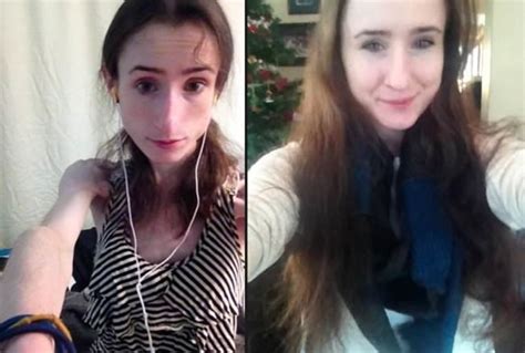 Brave Anorexia Survivor Posts Shocking Recovery Photos On Weight Loss