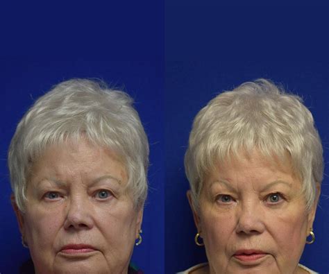 Brow Lifts East Lansing Plastic Surgery In Michigan