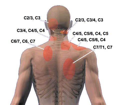 Cloward Sign And Cervical Referral Patterns Modern Manual Therapy Blog