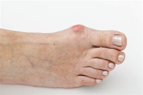 When Should I Consider Bunion Surgery Greater Houston Foot And Ankle