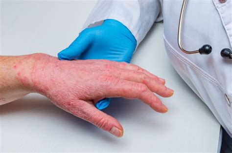 Síntomas Y Tratamientos De La Dermatitis En Las Manos Mejor Con Salud