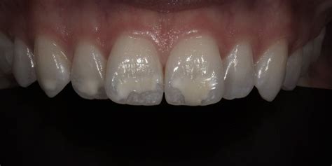 Removing White Spots From Teeth Dr Gurs Sehmi