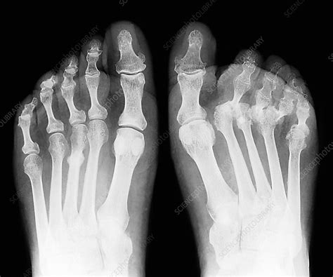 For more information and past images of the month, go to. Rheumatoid arthritis of the feet, X-ray - Stock Image ...